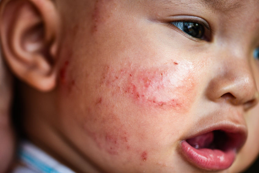 enfant avec de l'eczema